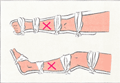 布で数か所、足の固定をしているイラスト