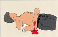 腕から出血した人が横たわり、上腕で止血をされているイラスト